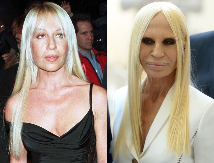 faeb0d7d0f5a3c9f0508ebdd865582f7 donatella versace plastic surgery